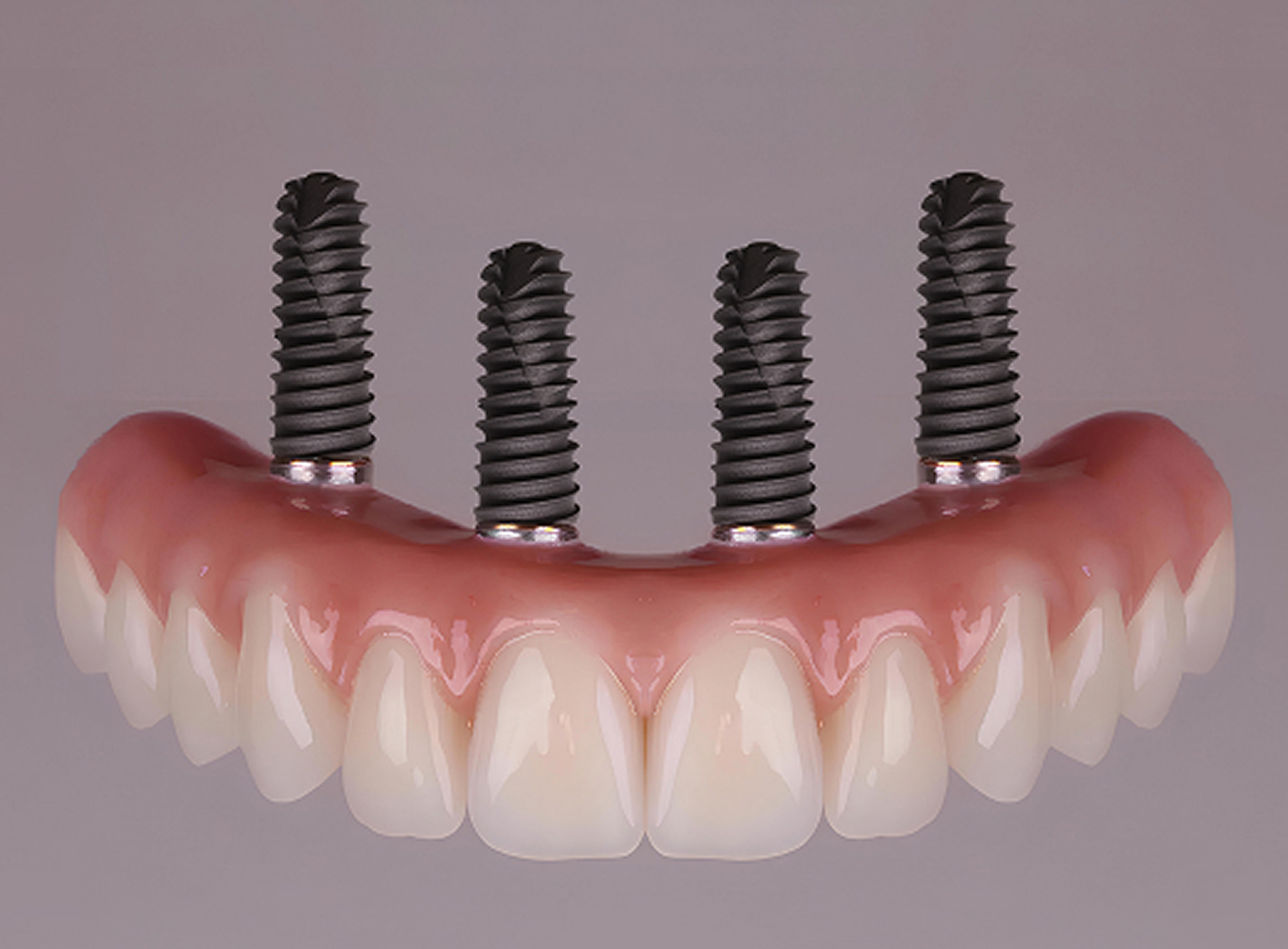 All-on-4 dental implants provide a same-day solution to restore your full smile with comfort and confidence.