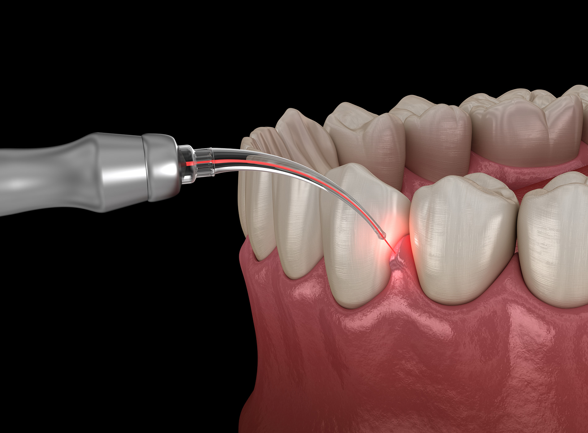 Deep cleaning with scaling and root planing treats advanced gum disease.