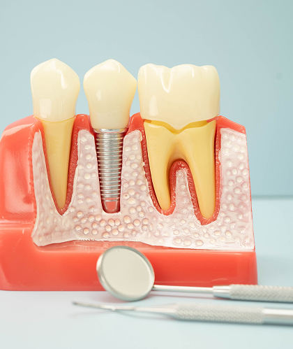 Single Tooth Implants