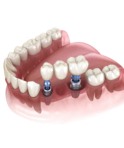 Implant-Supported Bridges
