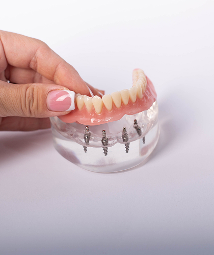 Implant Dentures